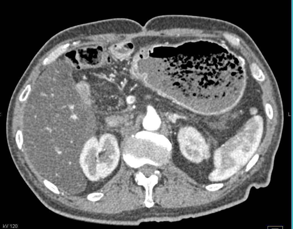 Delayed Gastric Emptying S/P Whipple Procedure - CTisus CT Scan