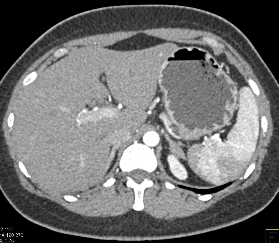 Neuroendocrine Tumor in the Head of the Pancreas - CTisus CT Scan