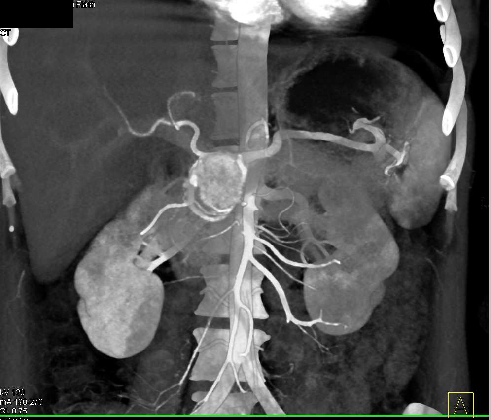 Neuroendocrine Tumor Head of Pancreas - CTisus CT Scan