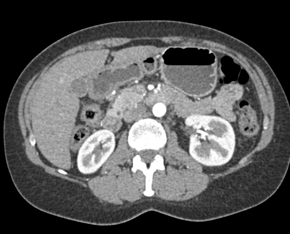 Normal Arterial and Venous Anatomy Around the Pancreas - CTisus CT Scan