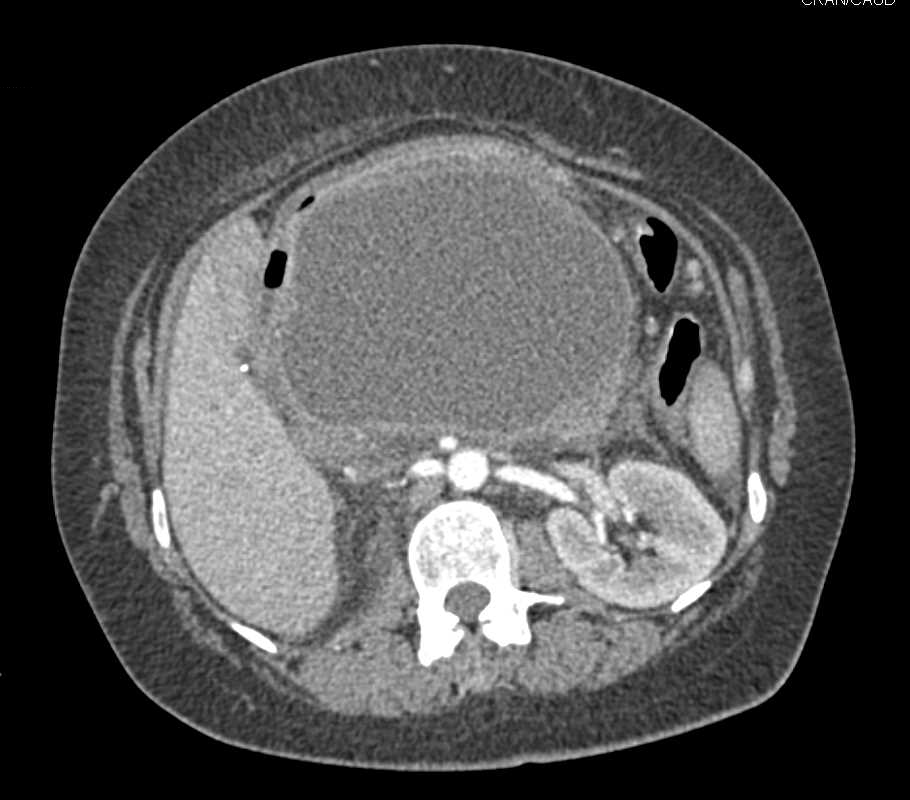 Large Pancreatic Pseudocyst with Mass Effect - CTisus CT Scan