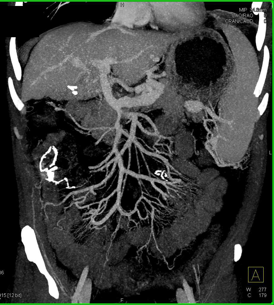 Pancreatic Cancer Invades the Portal Vein and Superior Mesenteric Vein (SMV) with Carcinomatosis - CTisus CT Scan