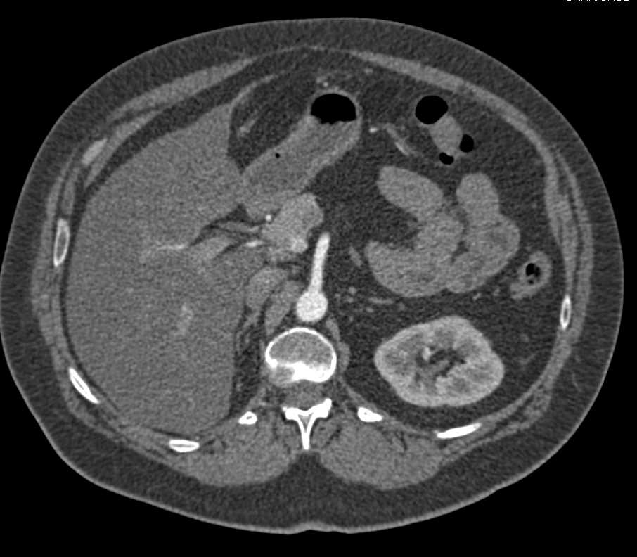 Metastatic Renal Cell Carcinoma to the Pancreas with Cystic Lesion - CTisus CT Scan