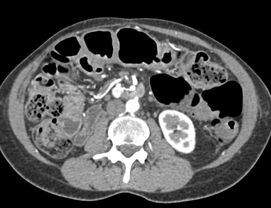 Recurrent Neuroendocrine Tumor with Adenopathy - CTisus CT Scan