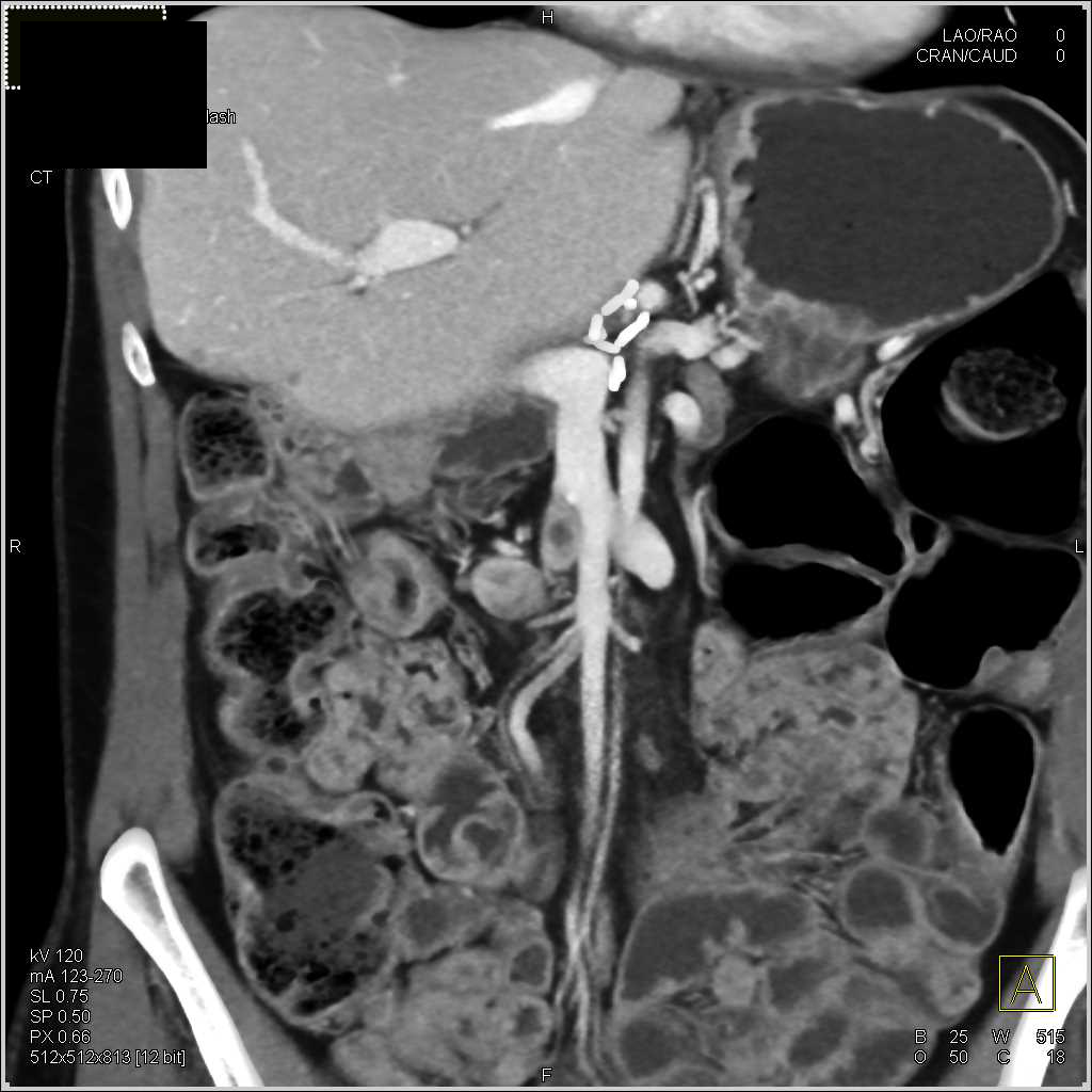 Neuroendocrine Tumor Near the Head of the Pancreas - CTisus CT Scan