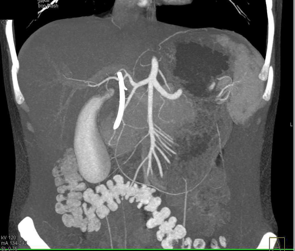 Opacified Gallbladder Following Endoscopic Retrograde Cholangiopancreatography (ERCP) and Stent Placement with Carcinoma of the Head of the Pancreas - CTisus CT Scan