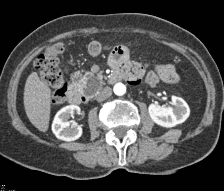 Intraductal Papillary Mucinous Neoplasm (IPMN) in the Head of the Pancreas - CTisus CT Scan