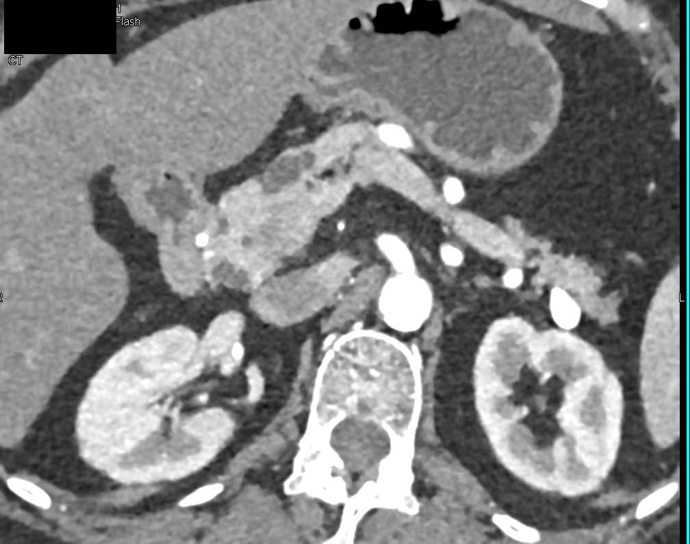 Multiple Intraductal Papillary Mucinous Neoplasms (IPMNs) - CTisus CT Scan