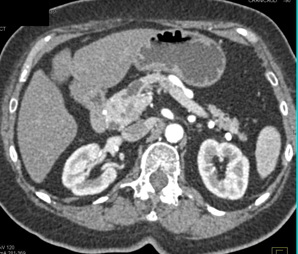 Multiple Pancreatic Intraductal Papillary Mucinous Neoplasms (IPMNs) - CTisus CT Scan