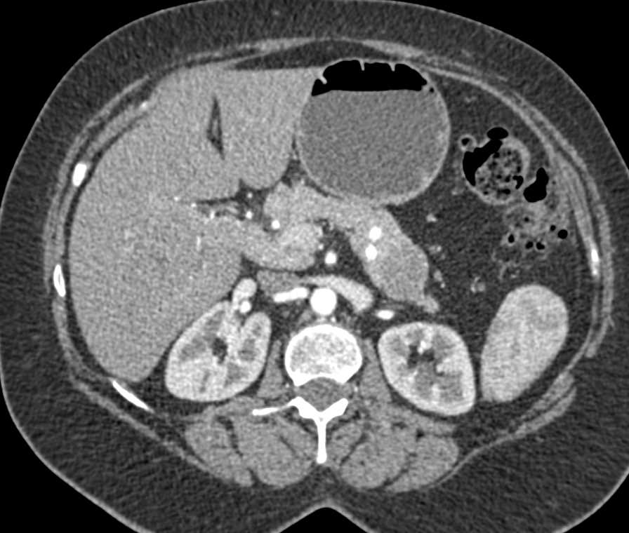 Carcinoma of the Tail of the Pancreas - CTisus CT Scan