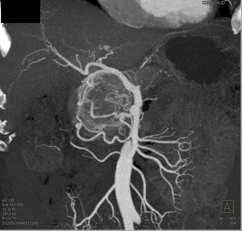 Serous Cystadenoma Pancreas with Increased Vascularity - CTisus CT Scan