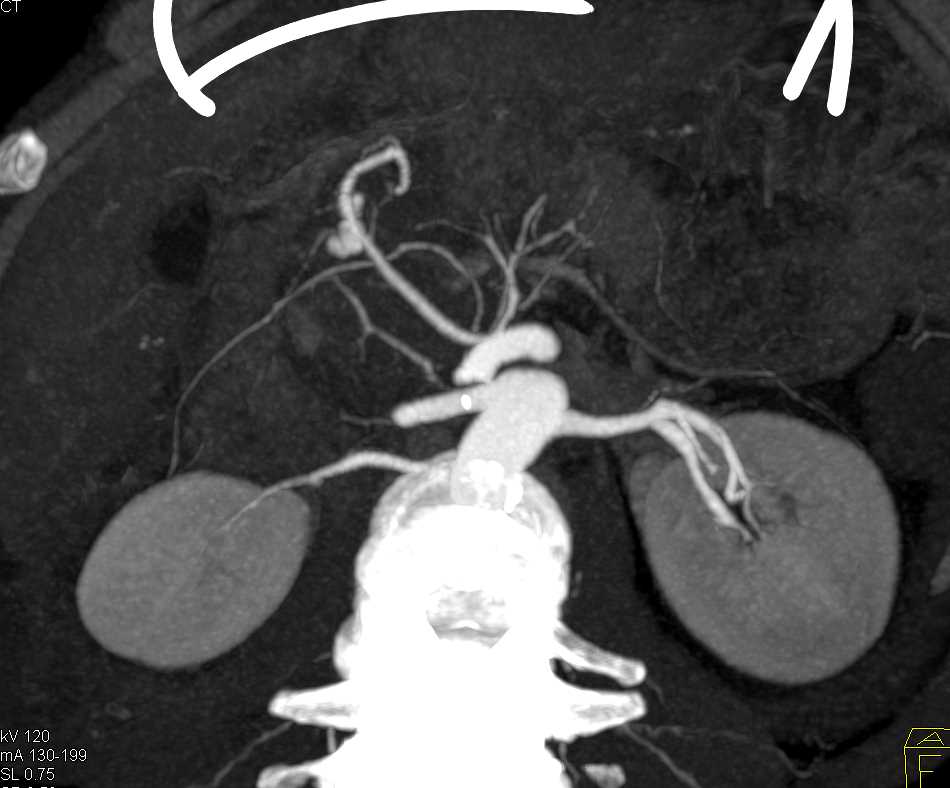CTA with Gastroduodenal Artery (GDA) Bleed Seen Best on MIP Images - CTisus CT Scan