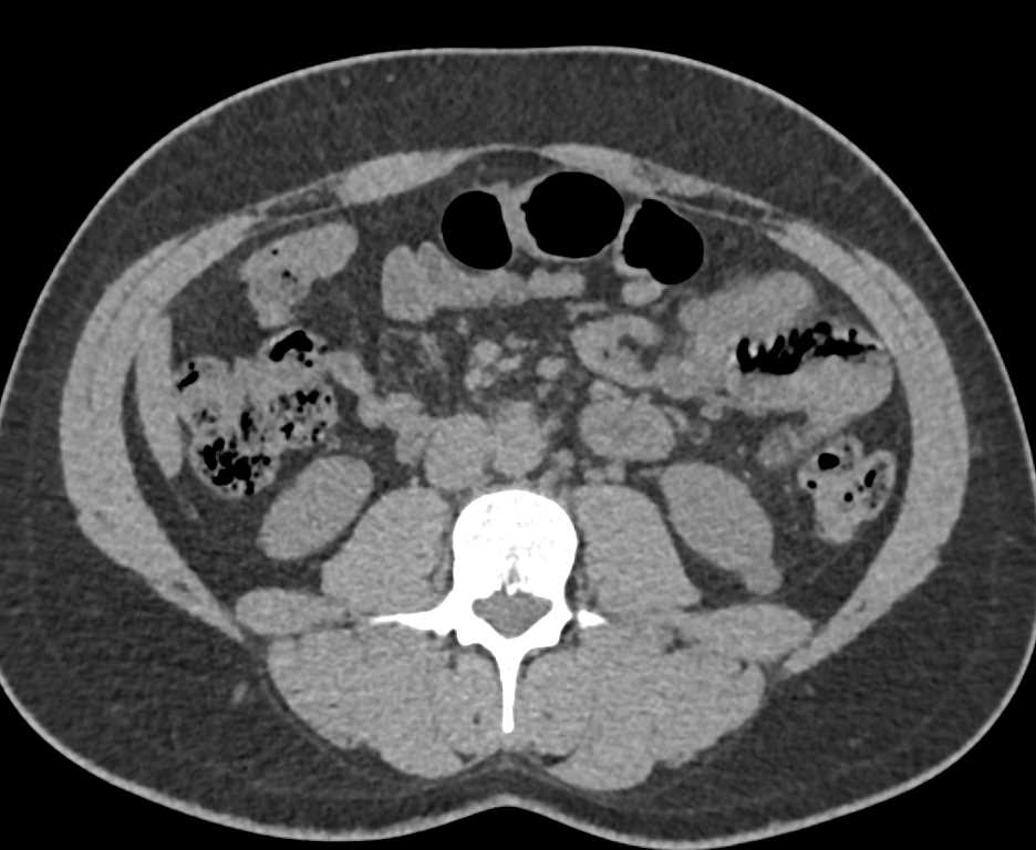 1 cm Left Papillary Renal Cell Carcinoma - CTisus CT Scan