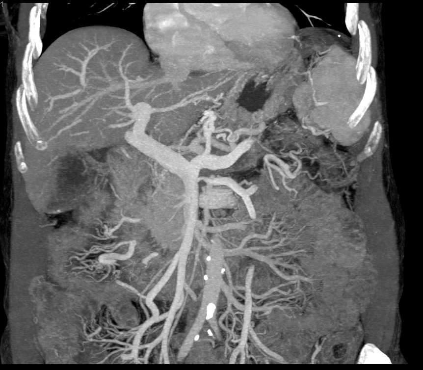 Pancreatic Cancer with Duodenal Involvement and Splenic Metastases - CTisus CT Scan