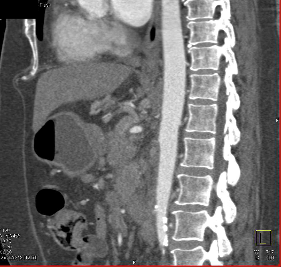 Pancreatic Cancer with Arterial and Venous Involvement and Liver Metastases - CTisus CT Scan