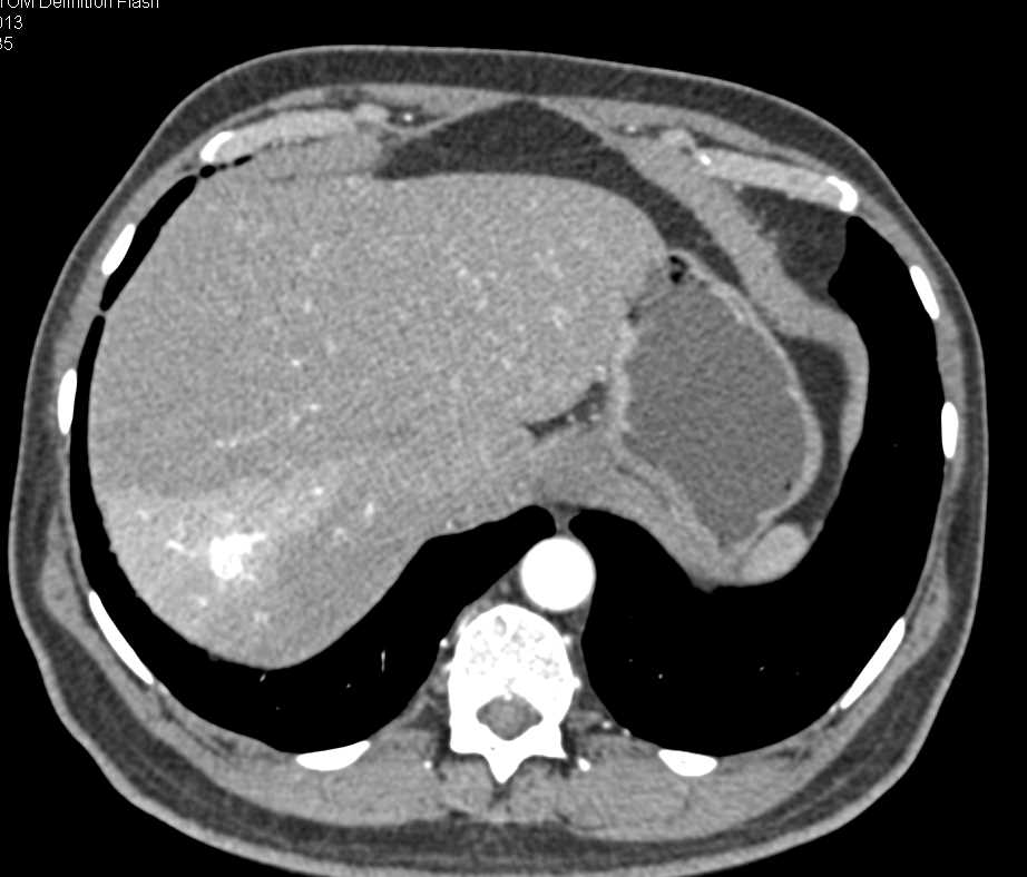 Neuroendocrine Tumor in the Head of the Pancreas - CTisus CT Scan