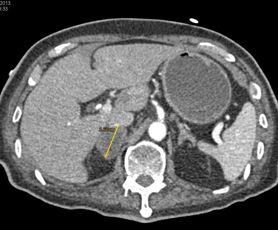 Adrenal Metastases in Pancreatic Cancer Patient - CTisus CT Scan