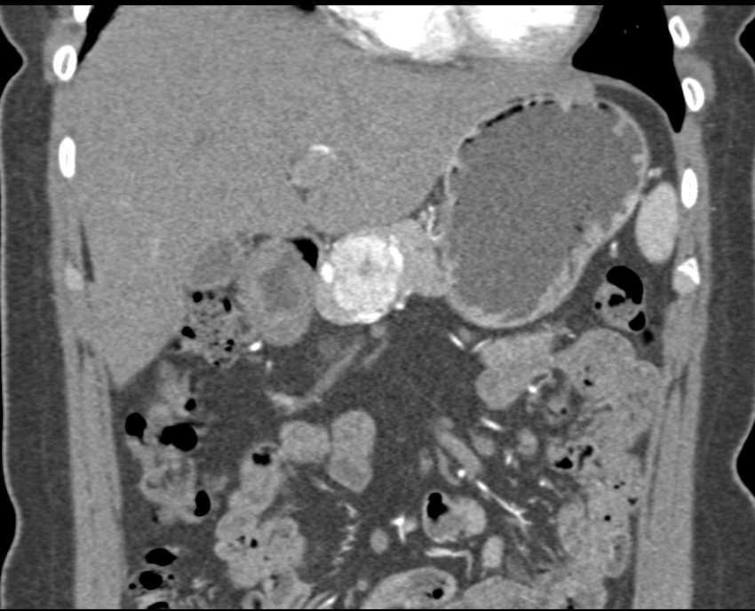 Neuroendocrine Tumor in the Head of the Pancreas - CTisus CT Scan