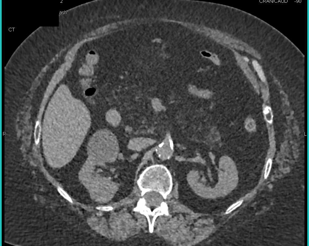 Fatty Replacement of the Pancreas in Cystic Fibrosis - CTisus CT Scan