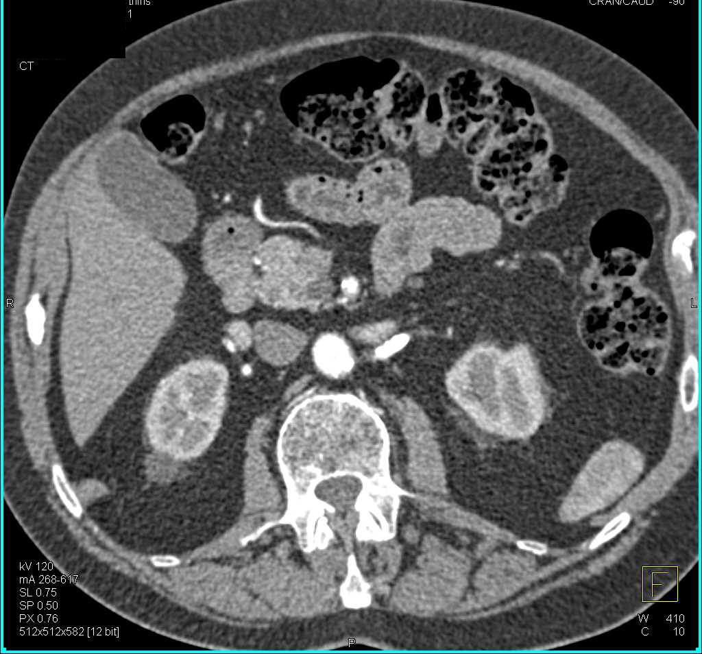 Ampullary Stricture due to Carcinoma - CTisus CT Scan