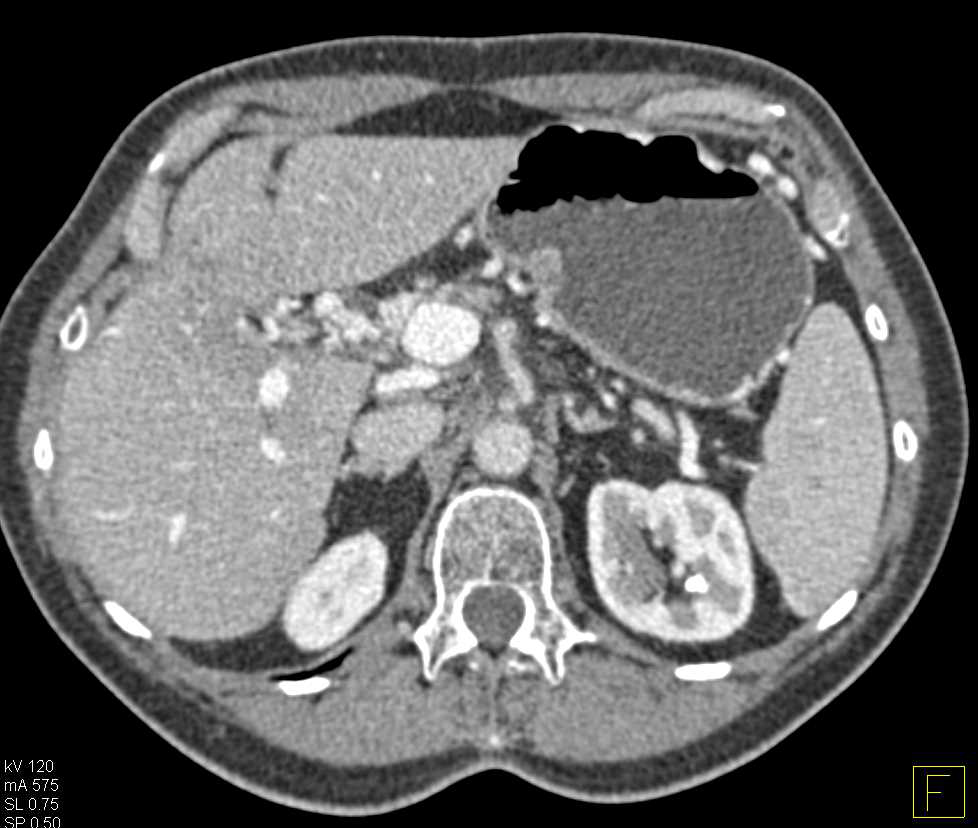 Carcinoma of the Body of the Pancreas with Fiduciary Clips - CTisus CT Scan