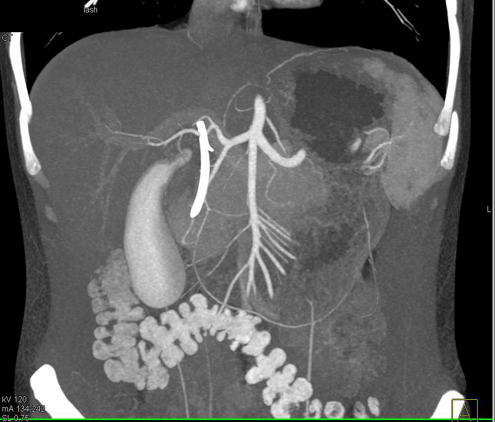 Carcinoma Head of Pancreas - CTisus CT Scan