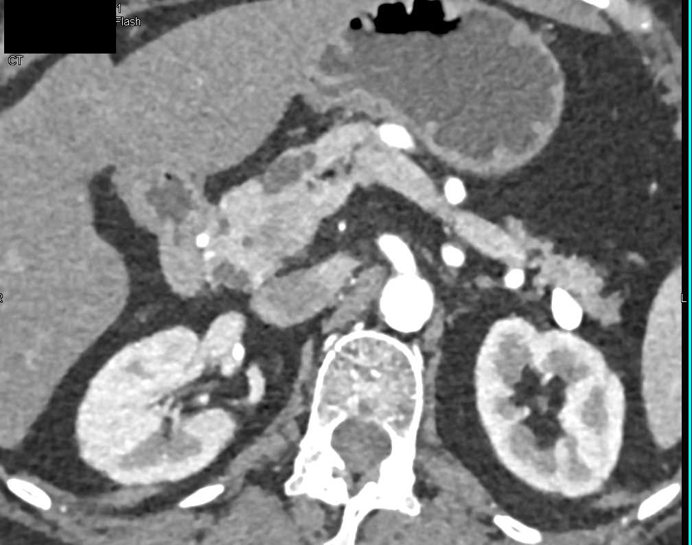 Central Intraductal Papillary Mucinous Neoplasm (IPMN) of the Pancreas with Dysplasia and Side Branch IPMNs - CTisus CT Scan