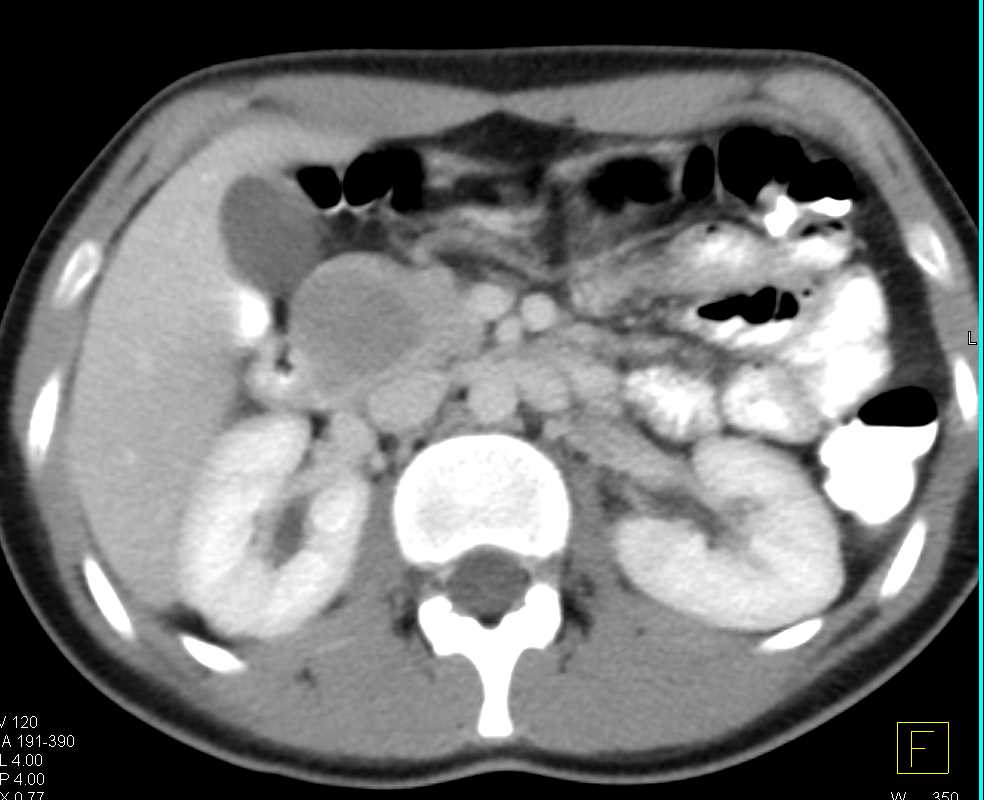 SPEN Tumor of the Pancreas - CTisus CT Scan