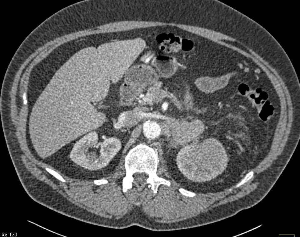 Lymphoma Involves the Spleen, Pancreas and Left Kidney - CTisus CT Scan