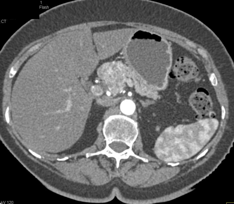 Neuroendocrine Tumor in the Body of the Pancreas - CTisus CT Scan