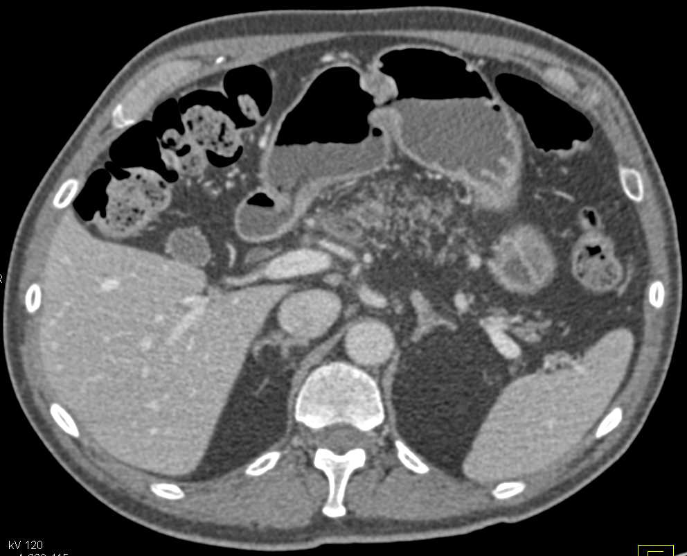 Cystic Lesion in Body of the Pancreas and Fatty Infiltration - CTisus CT Scan