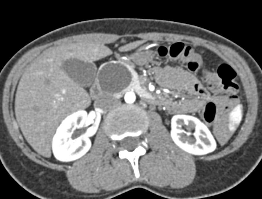 Serous Cystadenoma in the Head of the Pancreas - CTisus CT Scan