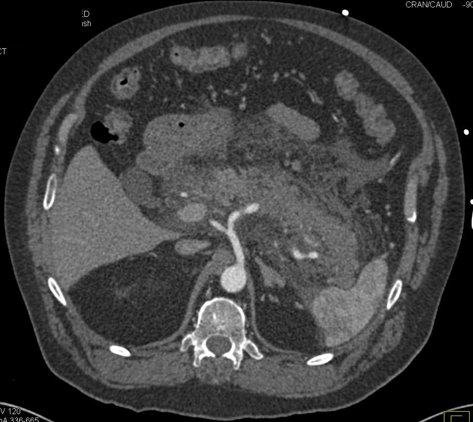 Acute Necrotizing Pancreatitis - CTisus CT Scan