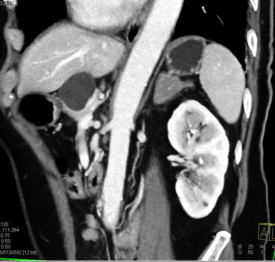 Serous Cystadenoma in the Head of the Pancreas - CTisus CT Scan