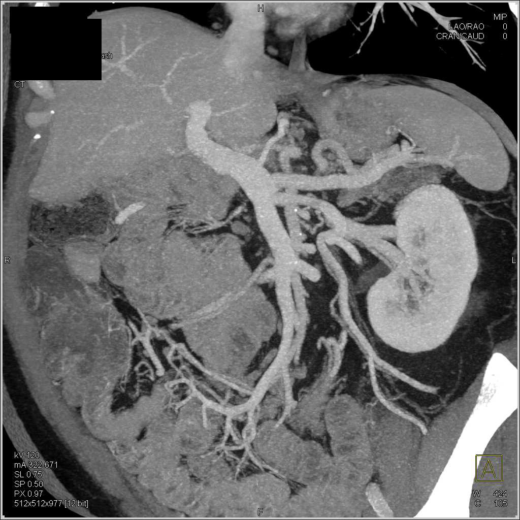 Intraductal Papillary Mucinous Neoplasm (IPMN) in the Tail of the Pancreas - CTisus CT Scan