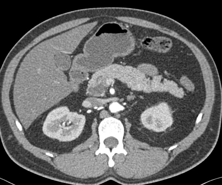 Serous Cystadenoma in the Head of the Pancreas - CTisus CT Scan