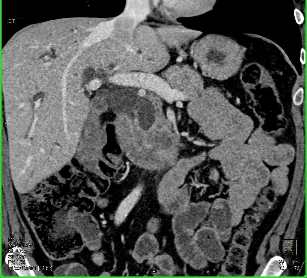 Pancreatic Cancer Obstructs the Common Bile Duct - CTisus CT Scan