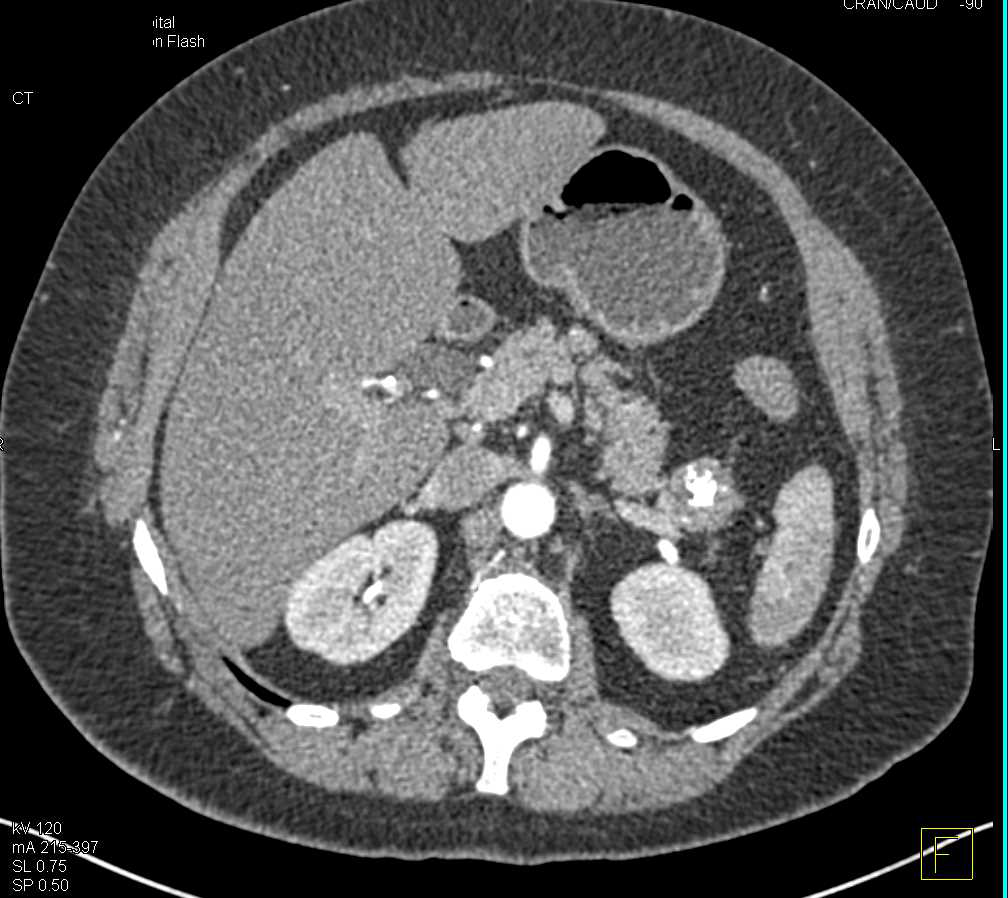 Partially Calcified Neuroendocrine Tumor in the Tail of the Pancreas - CTisus CT Scan