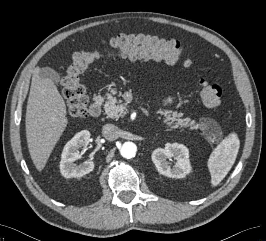 Lymphoepithelial Cyst Tail of Pancreas and Splenic Hemangiomas - CTisus CT Scan