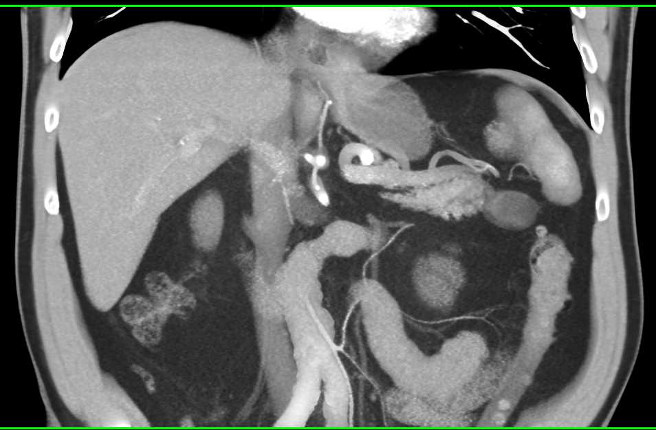 Lymphoepithelial Cyst Tail of Pancreas and Splenic Hemangiomas - CTisus CT Scan