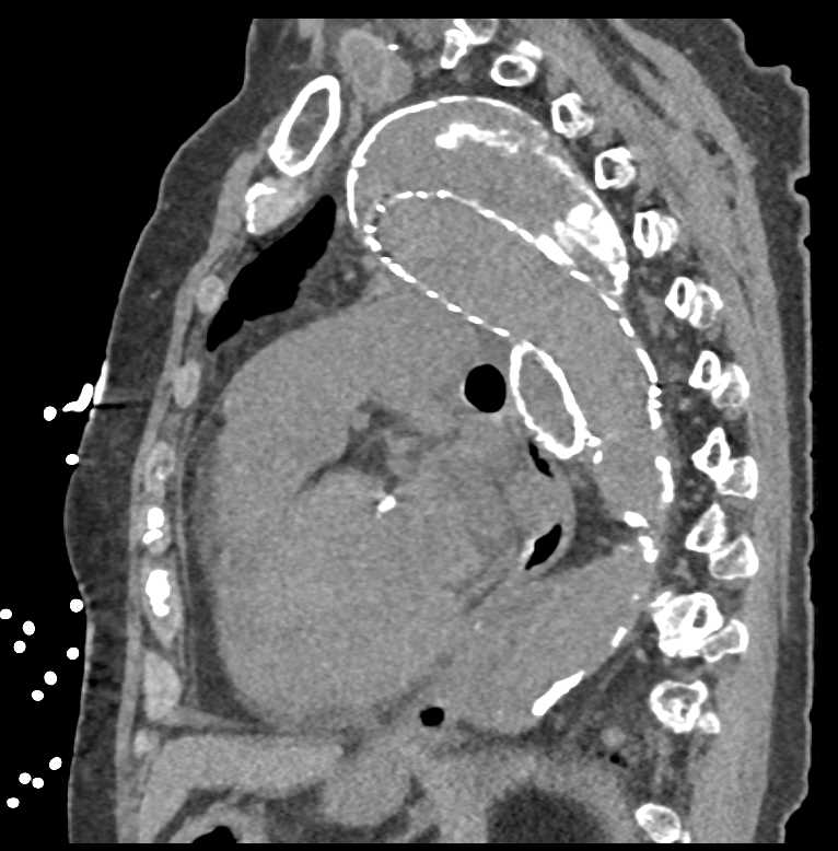Incidental Cystic Pancreatic Lesion in Patient with Aortic Dissection and Areas of Repair - CTisus CT Scan