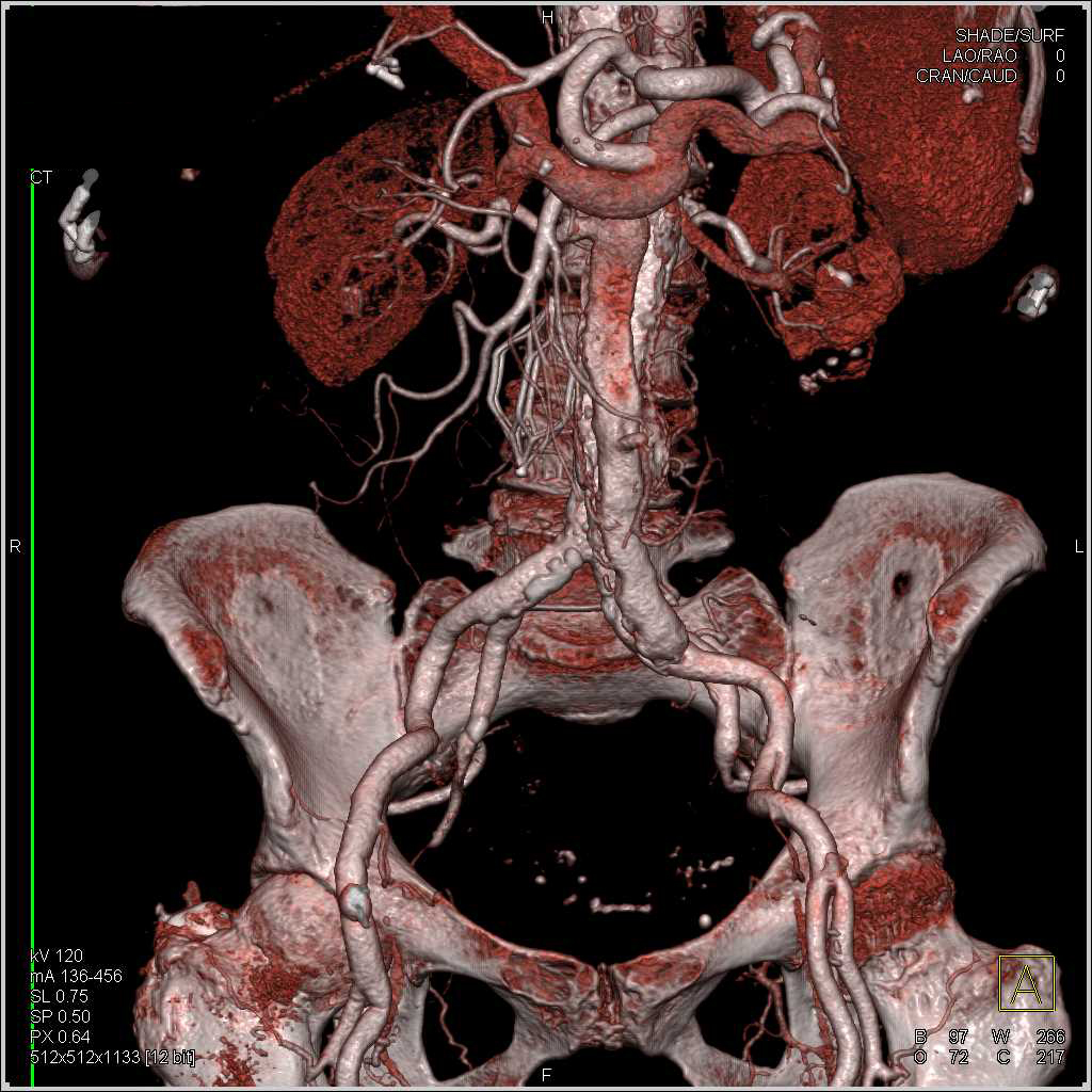 Incidental Cystic Pancreatic Lesion in Patient with Aortic Dissection and Areas of Repair - CTisus CT Scan