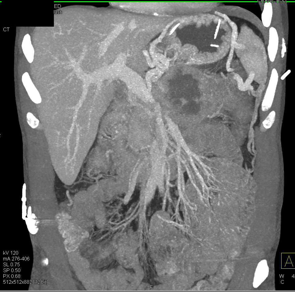 Necrotic Adenocarcinoma of the Pancreas - CTisus CT Scan