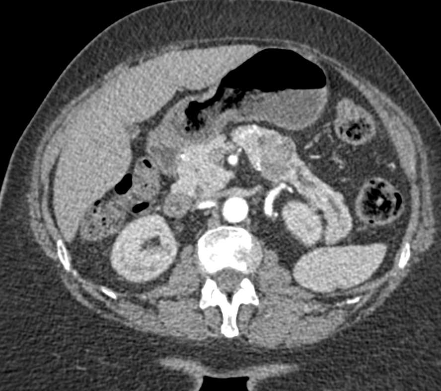 Carcinoma of the Body of the Pancreas - CTisus CT Scan