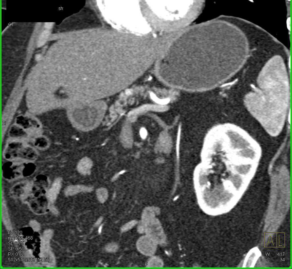 Metastatic Renal Cell Carcinoma to the Pancreatic Head - CTisus CT Scan