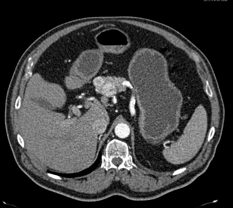 Metastatic Renal Cell Carcinoma Recurrence to the Pancreas - CTisus CT Scan