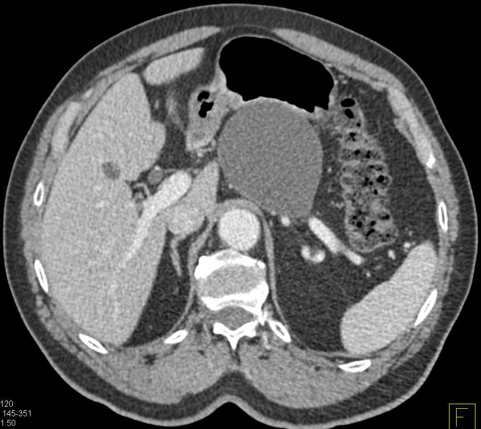 Pancreatic Pseudocyst - CTisus CT Scan