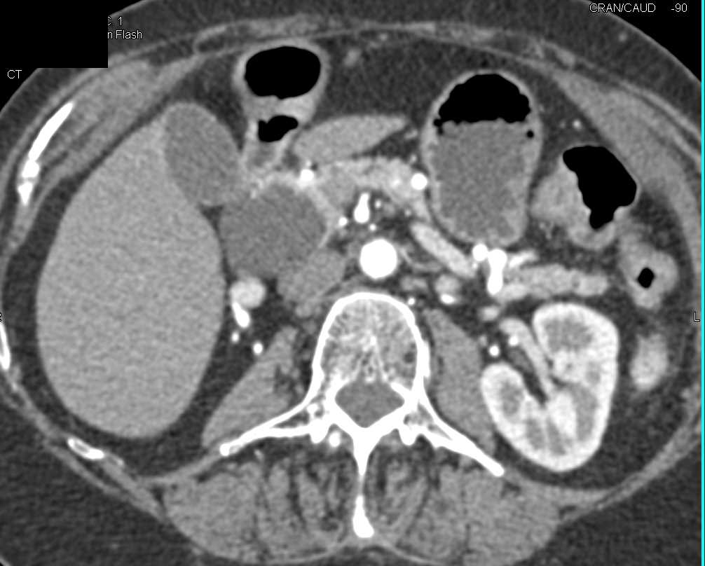 Intraductal Papillary Mucinous Neoplasm (IPMN) Head of Pancreas - CTisus CT Scan