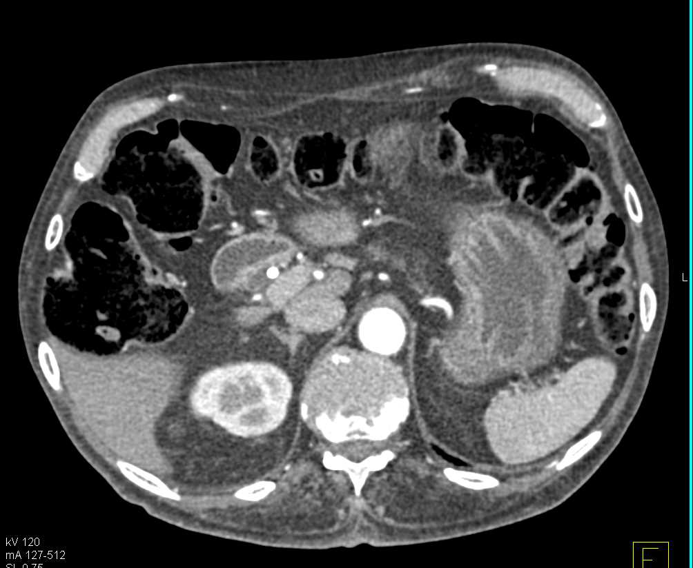 Autoimmune Pancreatitis Pre and Post Treatment - CTisus CT Scan