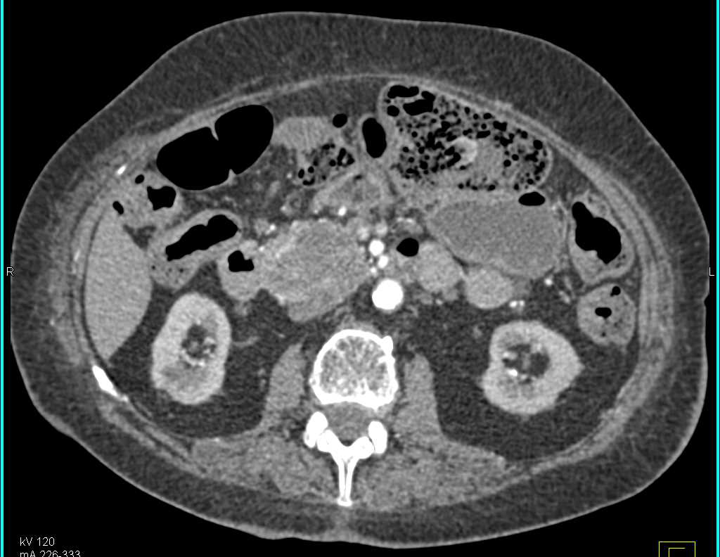 Pancreatic Cancer Invades the Portal Vein/SMV and Obstructs the Pancreatic Duct - CTisus CT Scan